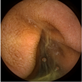 Picture for Low Complexity Image Compression of Capsule Endoscopy Images