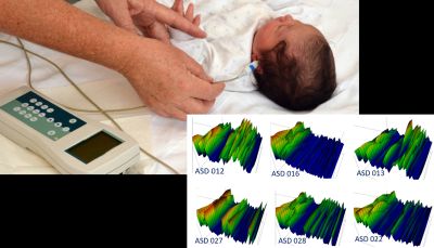 Picture for Otoacoustic Emissions (OAE) as a Tool for Early Autism Diagnosis